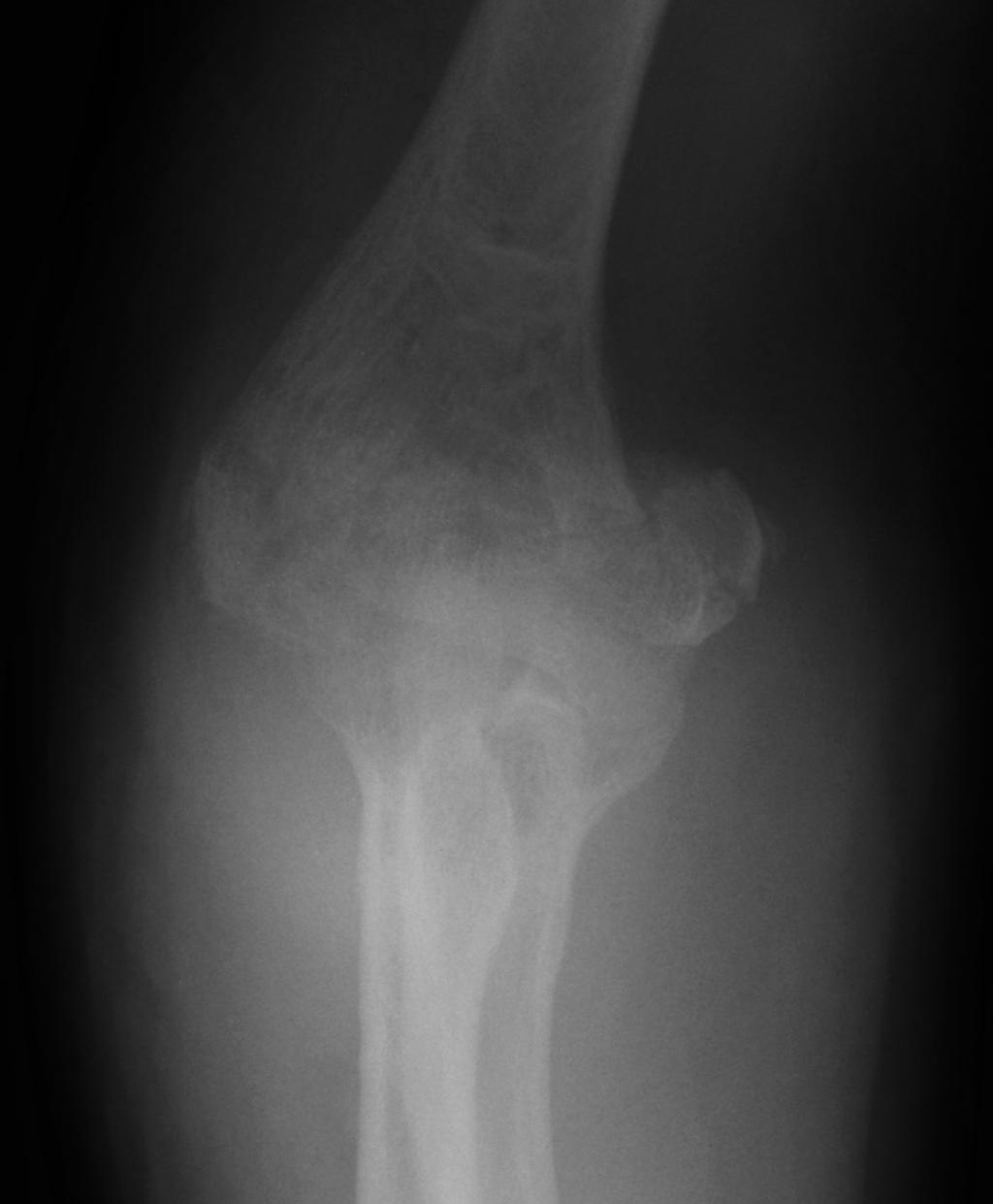 39 Low transcondylar fractures through osteopenic bone (Figs.