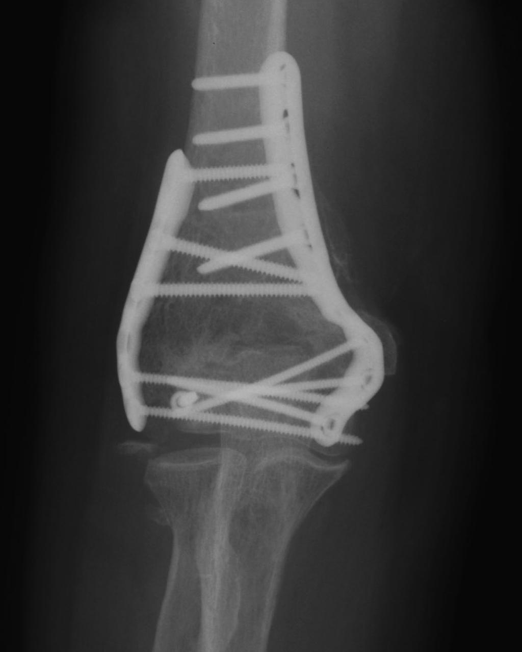 40 FIG. 8-C plates; one-third tubular plates are not strong enough for fixation of these complex fractures.