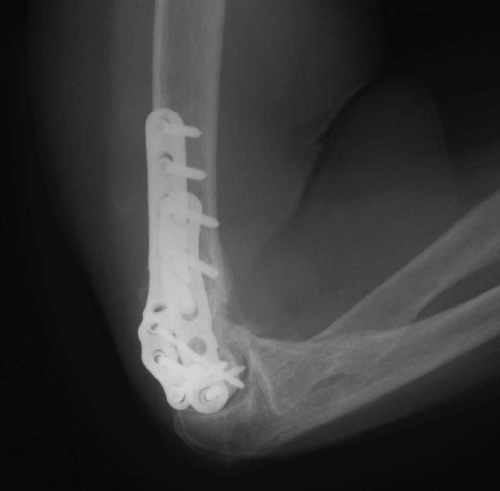 41 FIG. 8-D reduction of the distal fragments to the humeral shaft at the supracondylar level is confirmed.