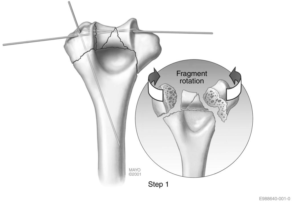 33 pedicle) approach provides adequate exposure for a surgeon experienced with the technique 5.