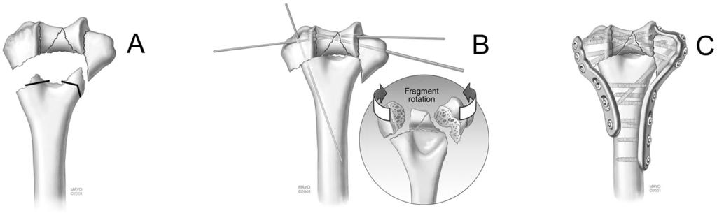7 In cases of supracondylar bone loss, and in some cases of severe comminution, anatomic placement of the distal part of the humerus with respect to the shaft would leave a large structural defect in