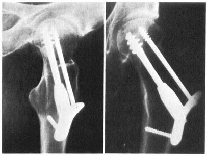 Internal fixation of femoral neck fractures 425 Figure 2. Femoral neck fracture operated with the compression screw. the day after admittance.
