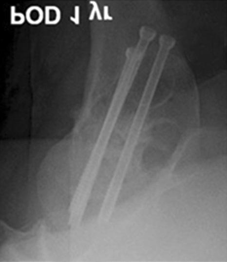 Center for right hip pain after a 1.5-m fall down.