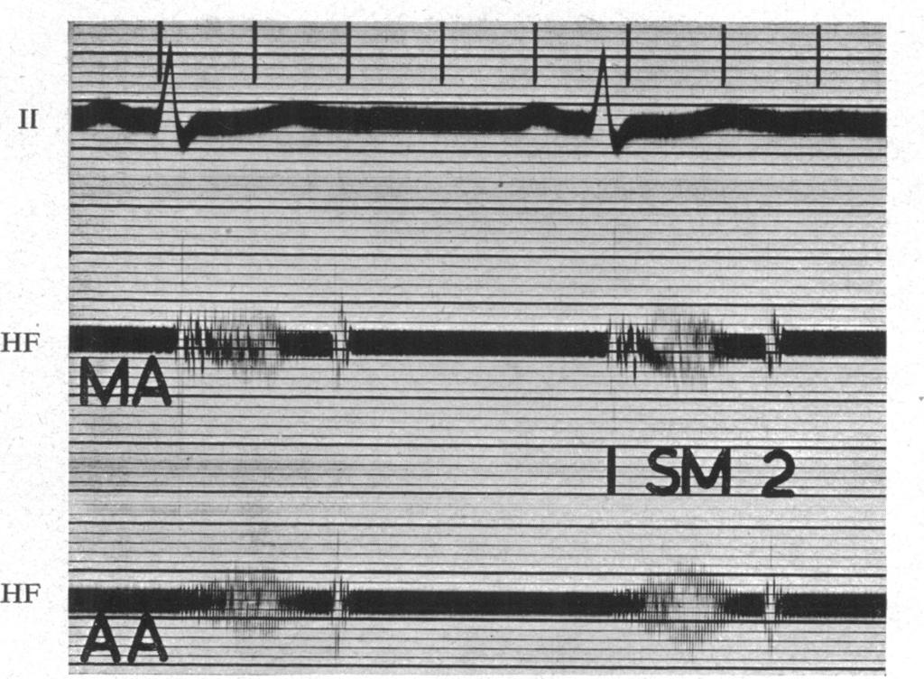 THE PHONOCRDOGRM OF ORTC STENOSS15 155 9 um n l d [ m,. FiG. 2.-ortic stenosis.