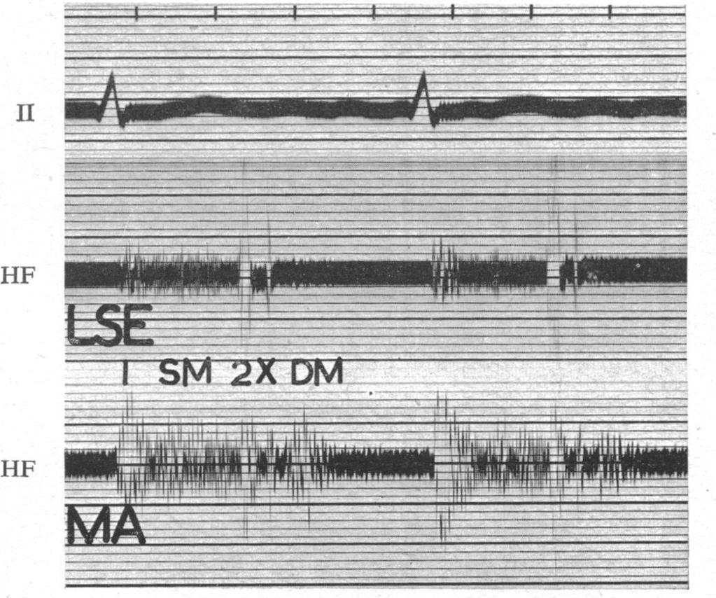 The systolic murmur fills systole between the first and second sounds.