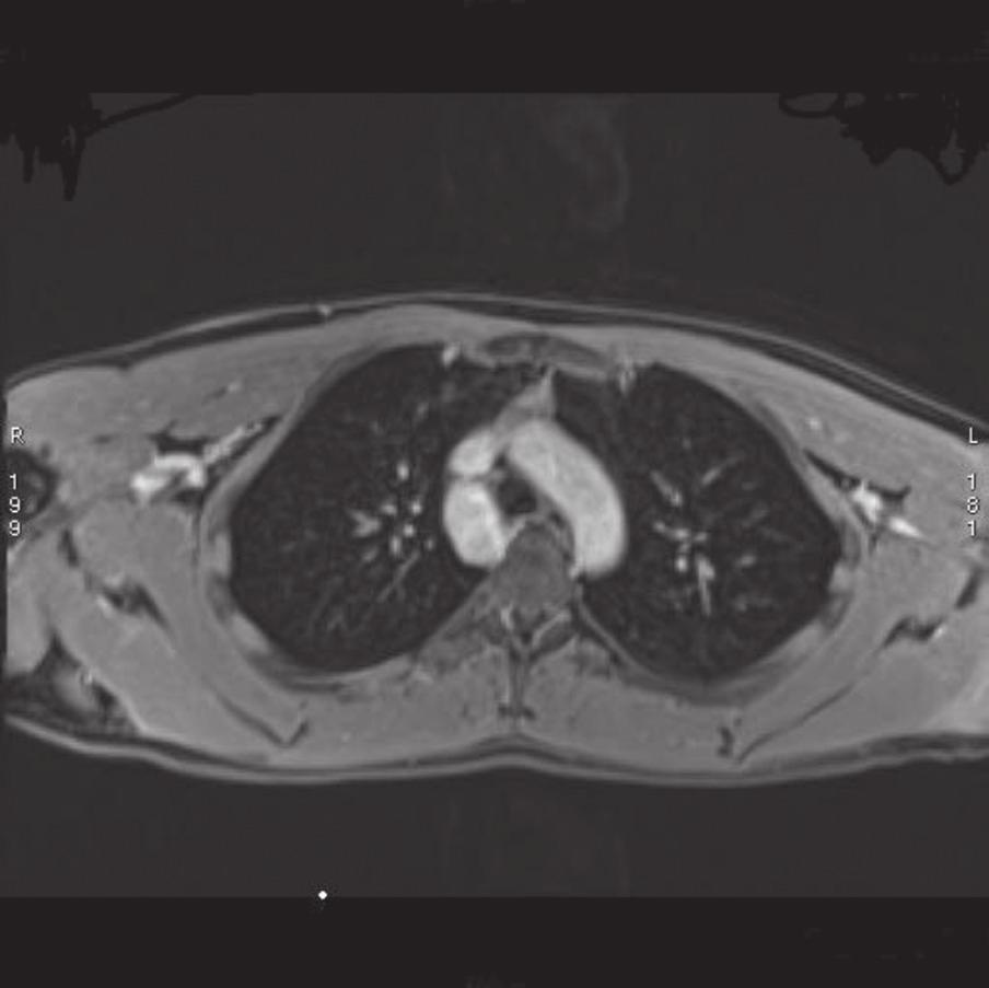 In order to complete the diagnostics, we performed magnetic resonance imaging (MRI) angiography of the thorax, which revealed the presence of widened azygos vein as the consequence of collateral