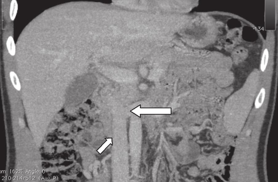 MRI of the thorax revealed no anatomical abnormalities in SVC, venous drainage on the left side and arterial system.