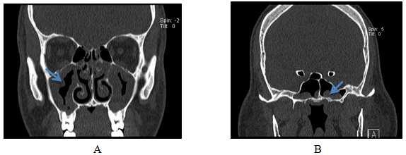 Patient s consent was obtained prior CT examination. Participants included 42 females and 47 males ranging in age from 20 to 72 years with the median age is 46 years. 2.3.