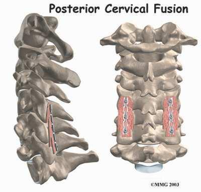 Introduction Posterior cervical fusion is done through the back posterior of the neck. The surgery joins two or more neck vertebrae into one solid section of bone.
