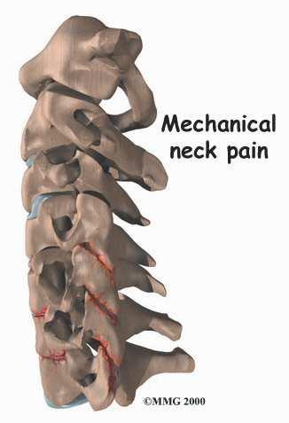 the neck are involved? Surgeons do this surgery through the back part of the neck The muscles on the back of the neck cover the bony ring around the spinal cord.