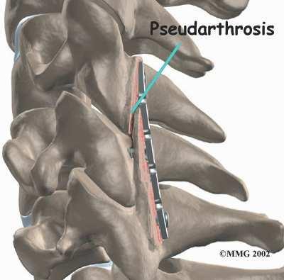 (The term pseudarthrosis means false joint.) If the joint motion from a nonunion continues to cause pain, you may need a second operation.