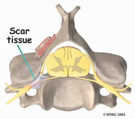 Problems with the Graft Fusion surgery requires bone to be grafted into the spinal column. The graft is commonly taken from the top rim of the pelvis.