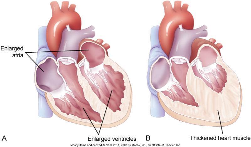 Fig. 35-1. A, Dilated heart chambers.