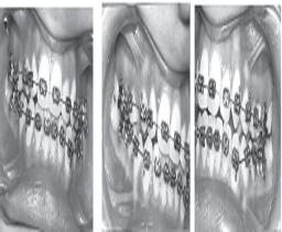 to brachyfacial form, competent lips at rest and normal TMJ activity (Figure-1). histories showed normal growth without any medical problem or trauma to the deciduous dentition.