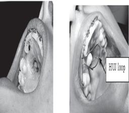 After leveling and alignment of arches, space was created for the accommodation of impacted tooth which was deemed to be surgically exposed and then brought into arch through a different mode of