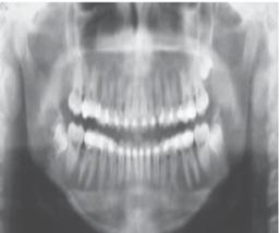 Second premolars were banded to bolster the anchorage. Treatment was continued in progressive mode.