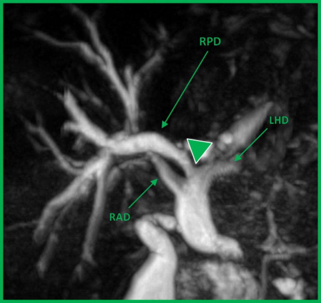 Fig. 6: "Right posterior duct draining into the left hepatic duct". Coronal oblique MIP reformat image of a dilated biliary tree.
