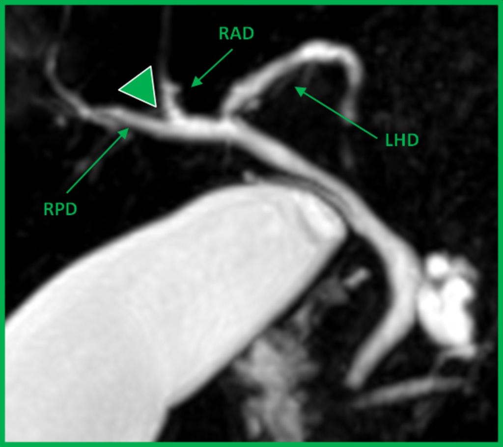 Fig. 8: "Right posterior duct joining with the right anterior duct by its lateral (right) side".