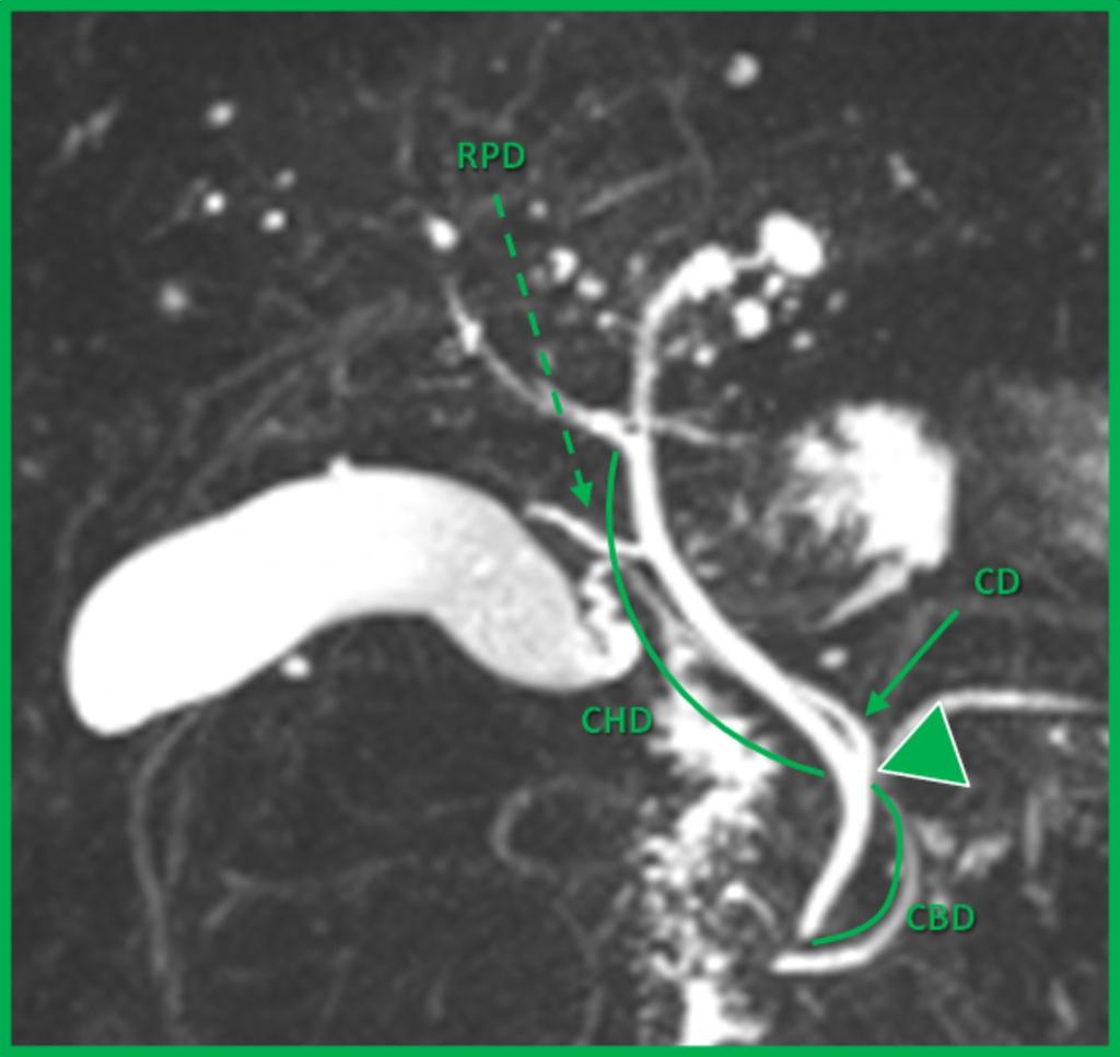 Fig. 14: "Low insertion of the cystic duct in the medial aspect of the common hepatic duct".