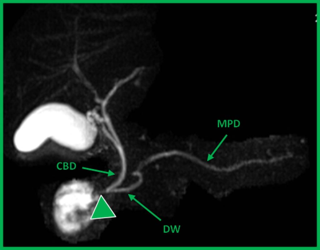 Fig. 21: "Normal pancreatic ductal anatomy".