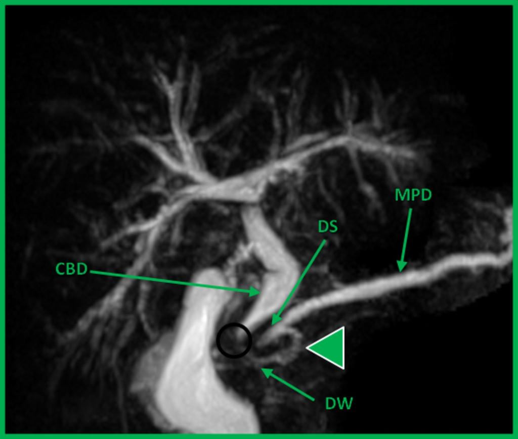 Fig. 26: "Incomplete pancreas divisum". Coronal oblique MIP reformat demonstrates the main pancreatic duct (MPD) draining at the minor papilla through the duct of Santorini (DS).