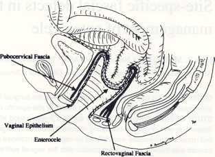 In rare cases detachment of the rectovaginal fascia from the posterior surface of the uterus occurs, resulting in a posterior enterocele with an intact uterus.