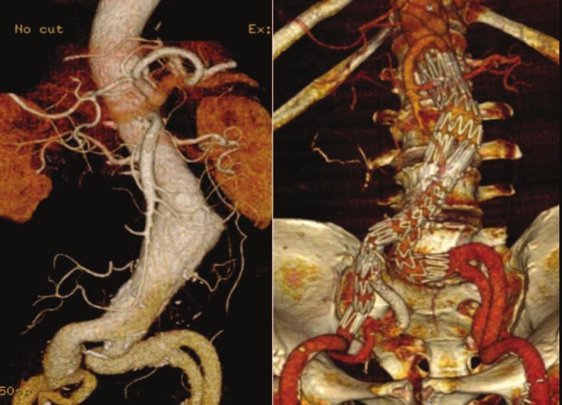 A B A B C Figure 1. An aorto-mono-iliac aneurysm with a challenging DSZ consisting of an aneurysmatic and tortuous right common iliac artery (A).