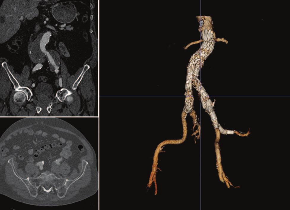 A C A B C B Figure 3. Use of an iliac side branch device to treat an aortoiliac aneurysm with a concomitant aneurysm of the left internal iliac artery (IIA).