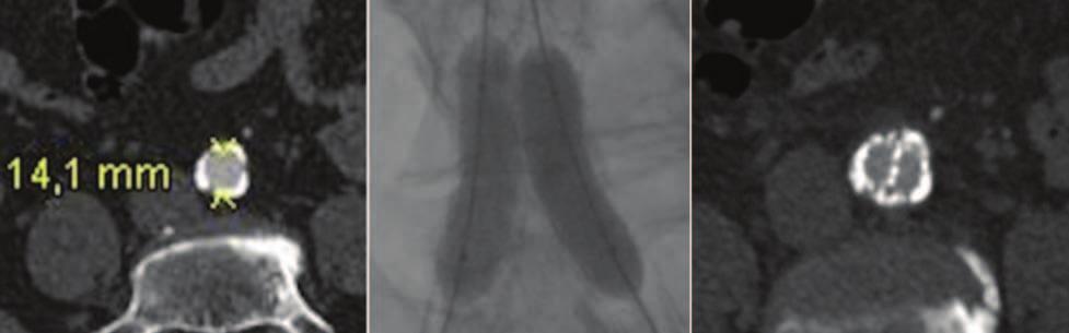 Control CTA confirming successful treatment of the IIA aneurysm by combining a balloon-expandable and a self-expanding stent graft and relining them with a self-expanding nitinol stent up to the