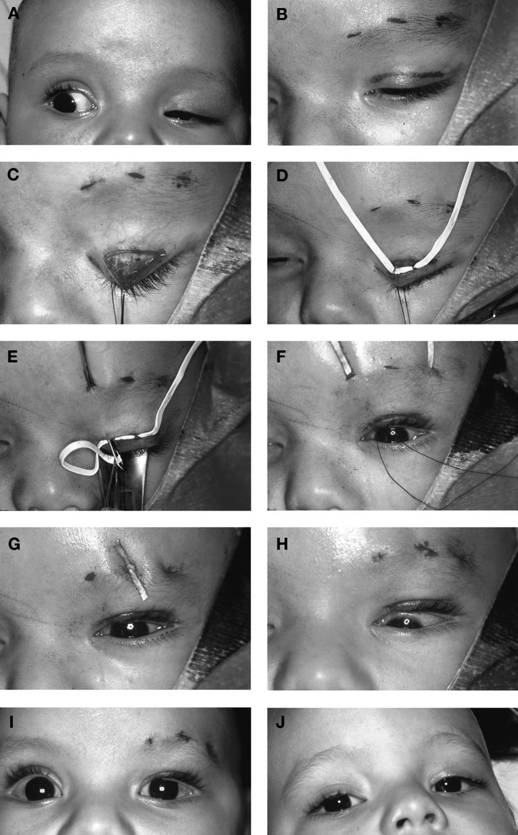 414 R. C. KERSTEN ET AL. FIG. 1. A, Three-month-old child with severe poor-function left upper eyelid ptosis thought to be at risk for amblyopia.
