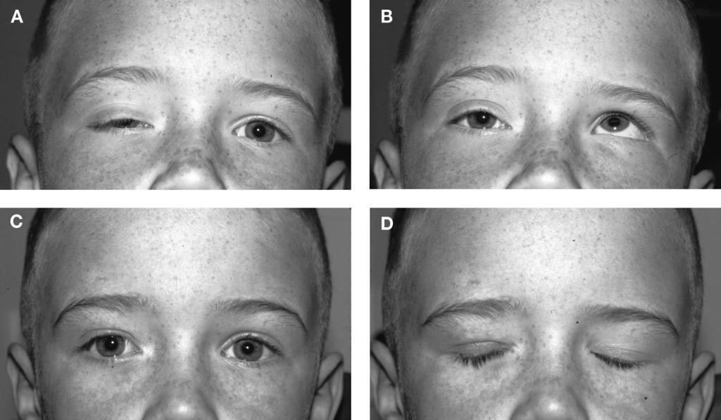 UNILATERAL SLING FOR UNILATERAL POOR-FUNCTION PTOSIS 415 FIG. 2. A, Ten-year-old child with history of congenital right IIIrd nerve palsy with marked ptosis.