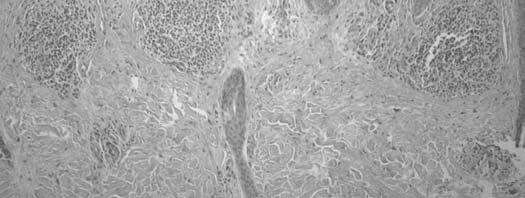 Explicit inflammatory cell infiltrates in