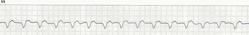Pacing QRS Duration A QRS duration over 200 ms has been arbitrarily proposed to suggest the upgrade of RV pacing in HF patients to BiV pacing.