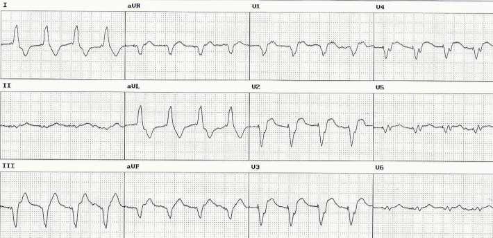 Pacing Induced Dyssynchrony Extremely wide QRS complexes are frequently observed in