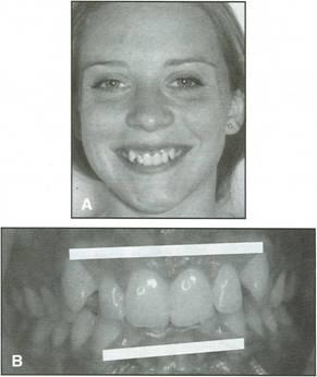 Treatment of an adult Class II patient requires careful diagnosis and a treatment plan involving esthetic, occlusal, and functional considerations.