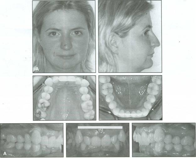 Case Report A 26-year-old female presented with the chief complaint of "my teeth stick out" (Fig. loa). She had a moderately convex hard and soft-tissue profile because of a retrusive mandible.