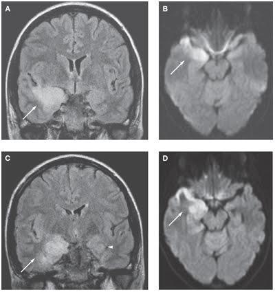 EVALUATION OF INFECTION ON DIFFUSION WEIGHTED IMAGING: Hyperintensity on DW MR images noted in herpes encephalitis. This restriction is due to cytotoxic edema in the tissue undergoing necrosis.