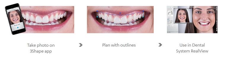 Design in a few minutes: What used to take ½ hour can now be done in a couple of minutes Esthetic design: Use your Smile Design to guide the 3D restorative design in the Dental System RealView Engine