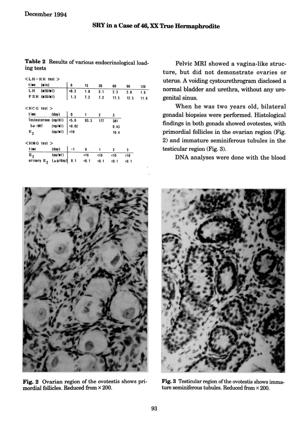 December 1994 SHY in a Case of 46, XX True Hermaphrodite Table 2 Results of various endocrinological loading tests Pelvic MRI showed a vagina-like structure, but did not demonstrate ovaries or uterus.