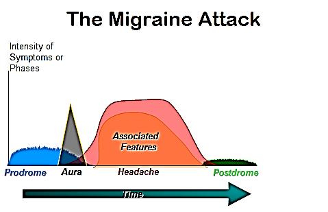 Understanding Migraines Migraine is a severe headache syndrome that recurs. Migraine headaches are usually throbbing, but may also be described as exploding, shooting, or squeezing.