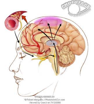 Chemicals in the brain cause blood vessel dilation and inflammation of surrounding tissue. The inflammation irritates the Trigeminal Nerve, resulting in pain.