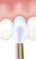 1 Clean teeth 2 H20 3 Clean and air dry 4 Concise 5 6 Etch 15 seconds Etching Liquid 7 H20/Suction 8 Transbond MIP