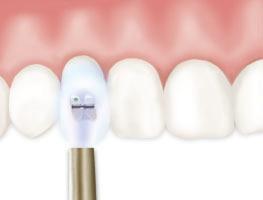 1 Clean teeth 2 H20/Suction 3 Press 4 Fold 5 Press 6 Mix 5 seconds Remove and apply 7 Rub 3-5 seconds 8 Re-dip for