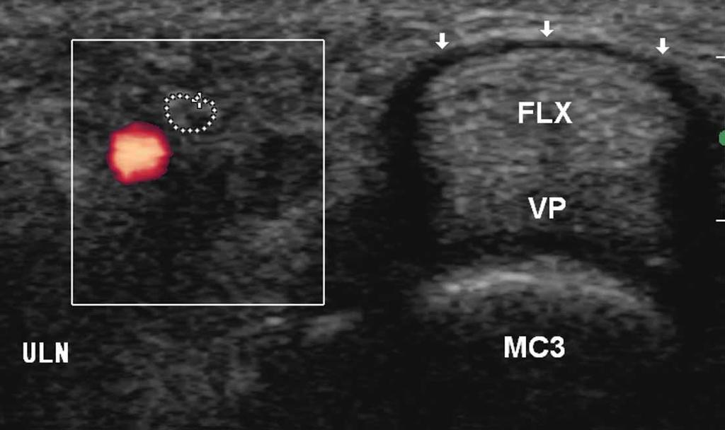 Sonographically Guided First Annular Pulley Release Figure 2. A, Long-axis view of the flexor tendons (FLX) showing the A1 pulley at the level of the third metacarpophalangeal joint.