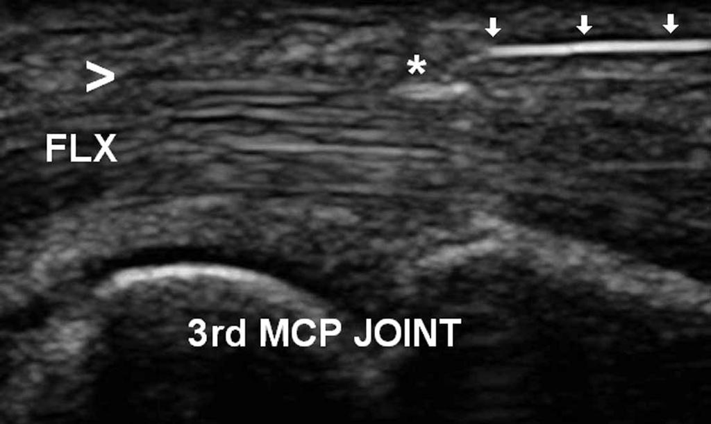 C, Long-axis view of the flexor tendons showing the A2 pulley at the level of the proximal phalanx (PP). Vertical arrows indicate the proximal and distal ends of the A2 pulley.