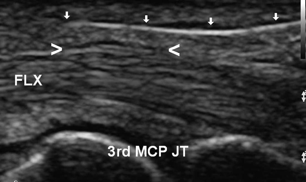 Smith et al action combined with tip elevation away from the underlying flexor tendons.