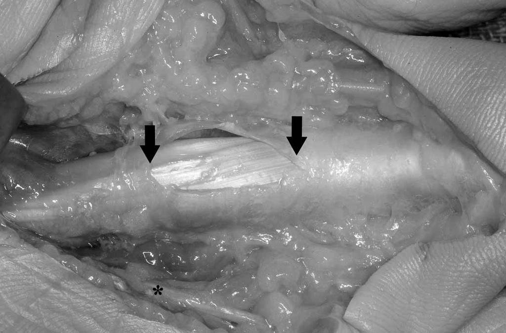 B, Dissection of incomplete index finger A1 pulley release performed using the needle technique. Release is incomplete distally (arrow). Orientation is similar to A.