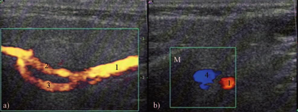 Medical Ultrasonography 2010; 12(3): 238-244 239 Fig 1. Normal US aspect of the parotid gland: a) power Doppler US, longitudinal scan; b) color Doppler US, transverse scan.