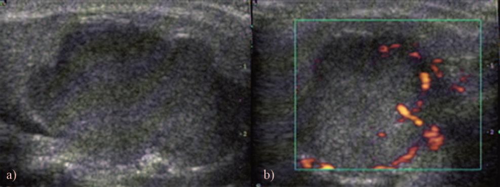 240 Daniela Fodor et al Gray scale and Doppler ultrasonography of the benign tumors of parotid gland Fig 3.