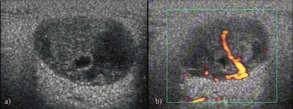 Medium pleomorphic adenoma a) gray scale US; b) power Doppler US, with characteristic US findings: lobular shape, well defined boundaries,